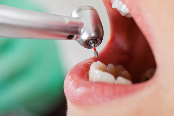 Best Emergency Broken Tooth Repair in Horseshoe Bay, TX